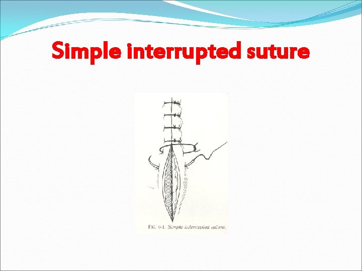 Simple interrupted suture 