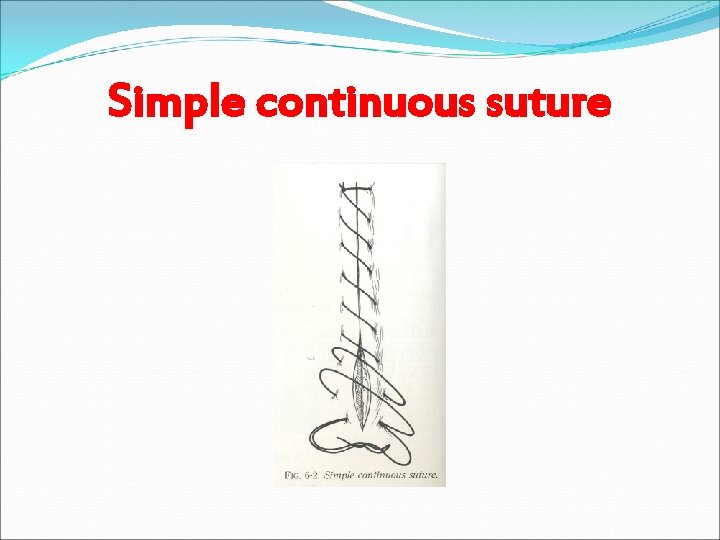 Simple continuous suture 