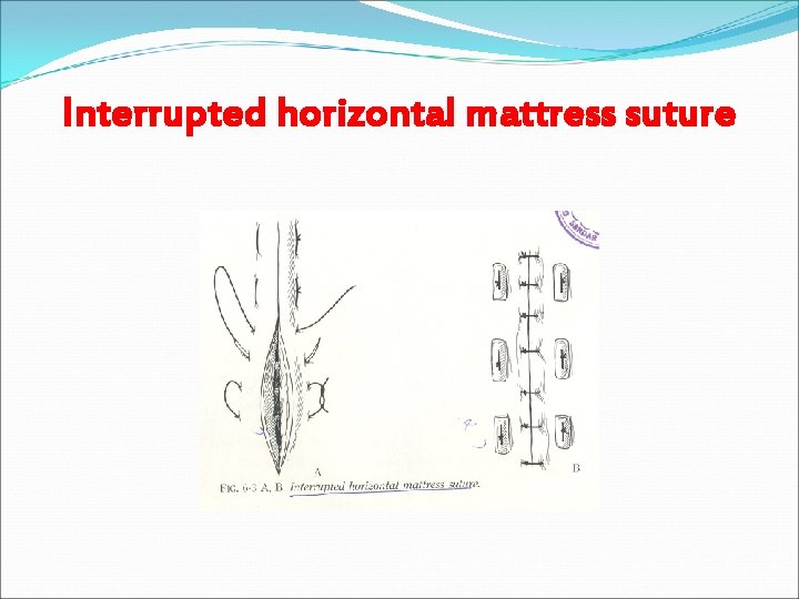 Interrupted horizontal mattress suture 