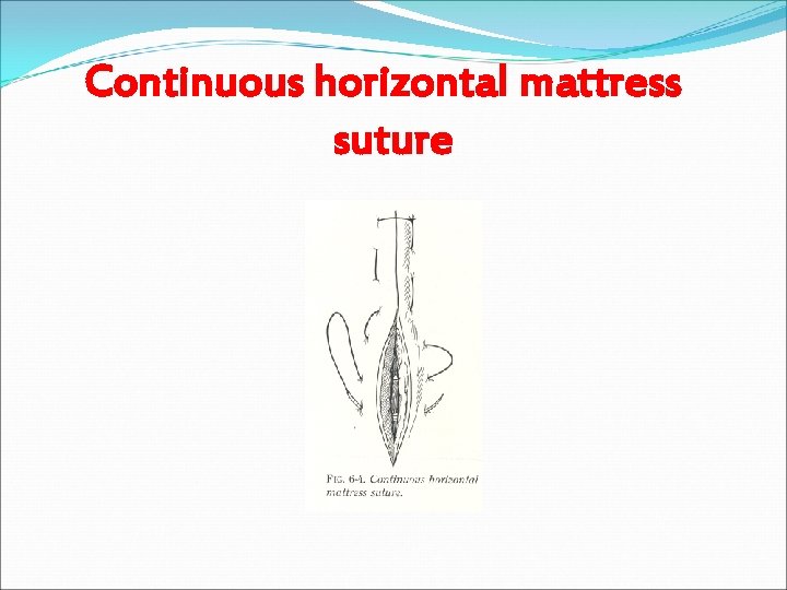 Continuous horizontal mattress suture 