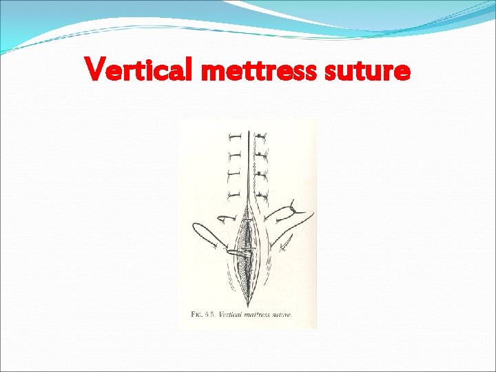 Vertical mettress suture 
