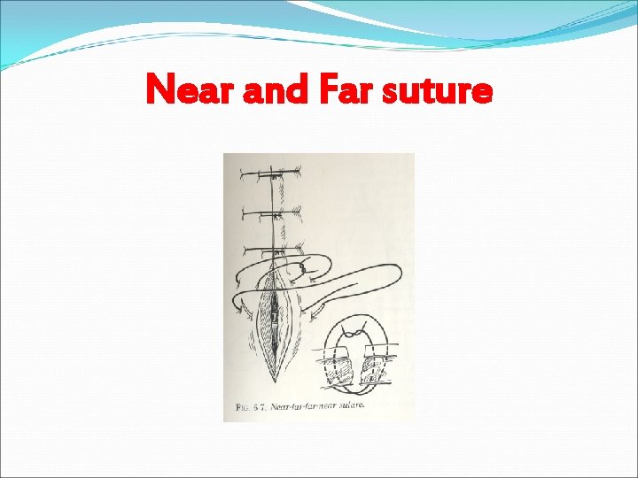 Near and Far suture 