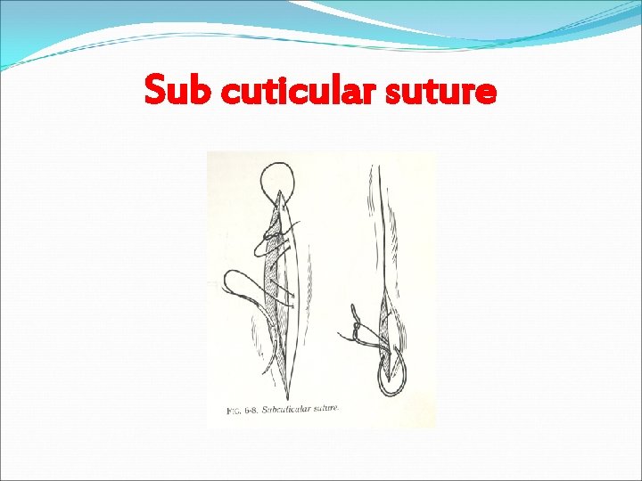 Sub cuticular suture 