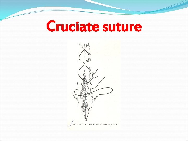 Cruciate suture 