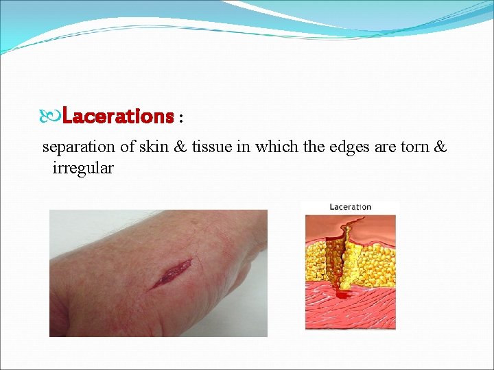  Lacerations : separation of skin & tissue in which the edges are torn