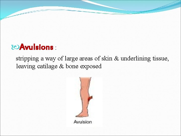  Avulsions : stripping a way of large areas of skin & underlining tissue,