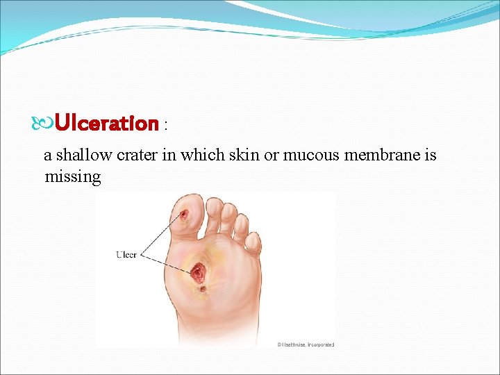  Ulceration : a shallow crater in which skin or mucous membrane is missing