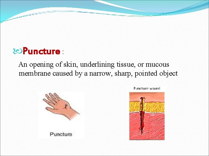  Puncture : An opening of skin, underlining tissue, or mucous membrane caused by