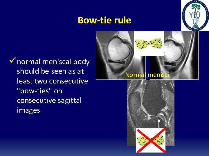 Bow-tie rule ünormal meniscal body should be seen as at least two consecutive "bow-ties"