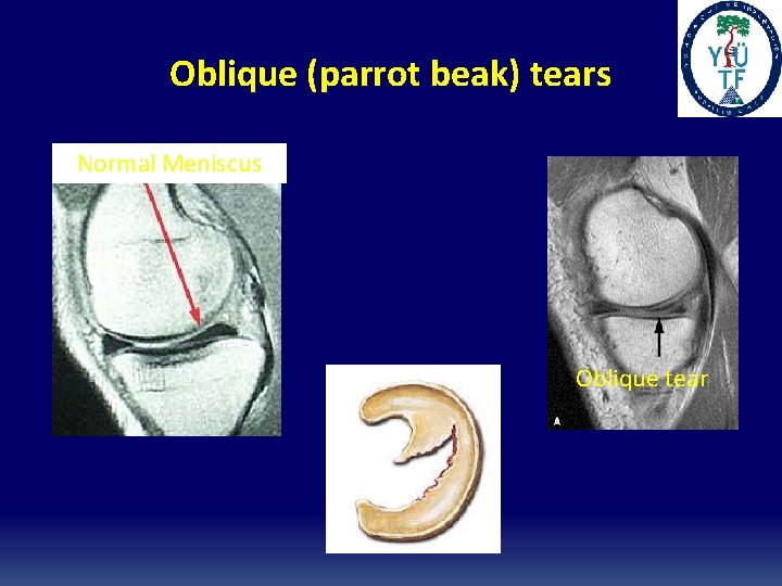 Oblique (parrot beak) tears Normal Meniscus Oblique tear 