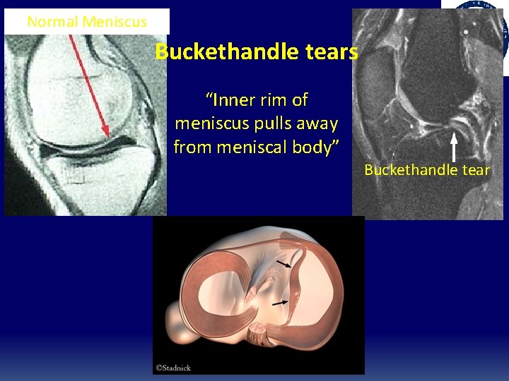 Normal Meniscus Buckethandle tears “Inner rim of meniscus pulls away from meniscal body” Buckethandle