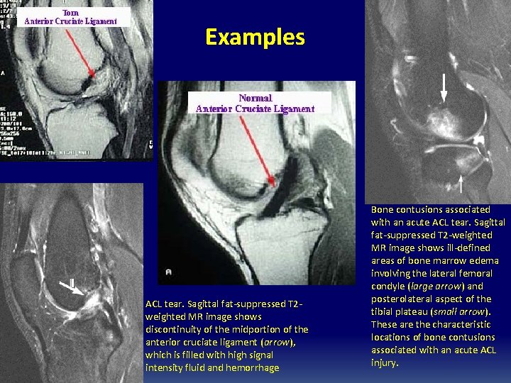 Examples ACL tear. Sagittal fat-suppressed T 2 weighted MR image shows discontinuity of the