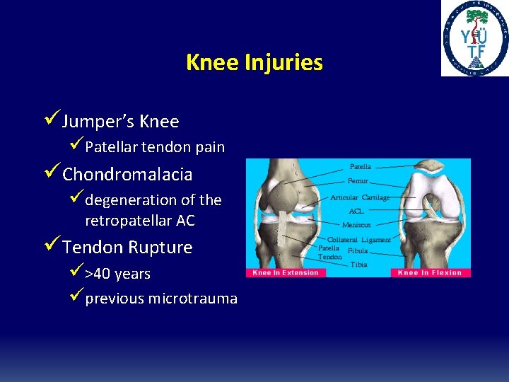 Knee Injuries üJumper’s Knee üPatellar tendon pain üChondromalacia üdegeneration of the retropatellar AC üTendon