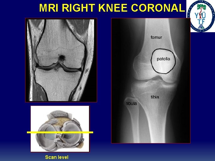 MRI RIGHT KNEE CORONAL Scan level 