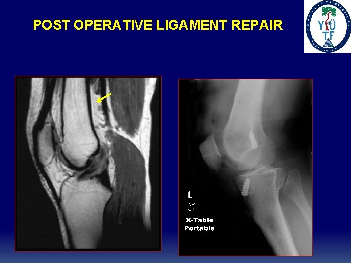 POST OPERATIVE LIGAMENT REPAIR 