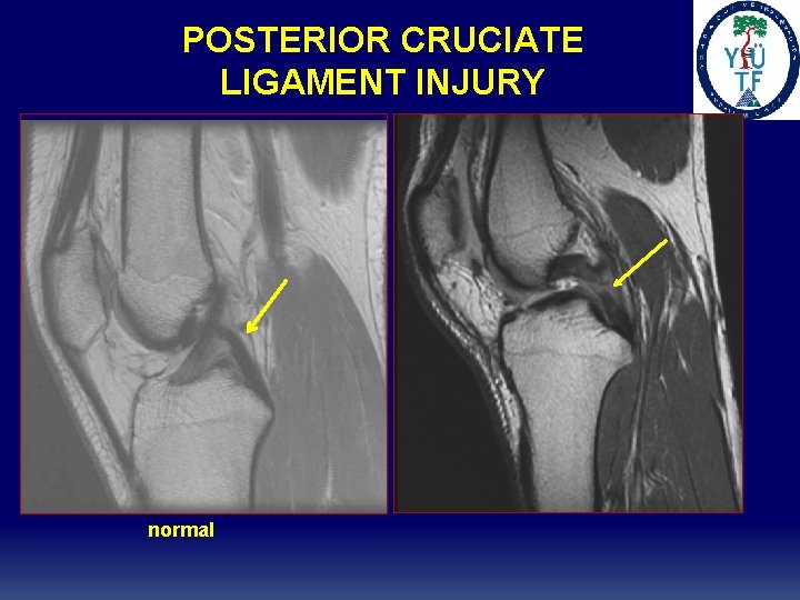 POSTERIOR CRUCIATE LIGAMENT INJURY normal 