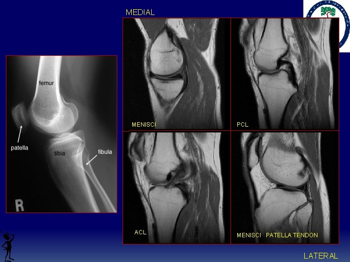 MEDIAL - MENISCI ACL PCL MENISCI PATELLA TENDON LATERAL 