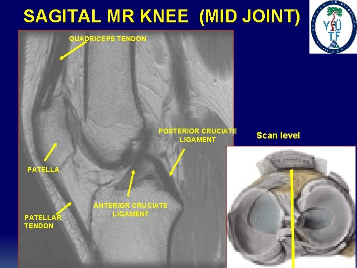 SAGITAL MR KNEE (MID JOINT) QUADRICEPS TENDON POSTERIOR CRUCIATE LIGAMENT PATELLAR TENDON ANTERIOR CRUCIATE