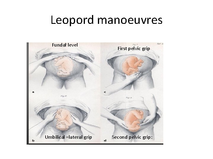 Leopord manoeuvres Fundal level Umbilical =lateral grip First pelvic grip Second pelvic grip: 