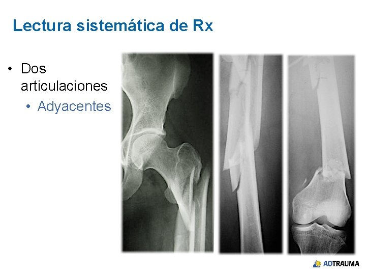 Lectura sistemática de Rx • Dos articulaciones • Adyacentes 