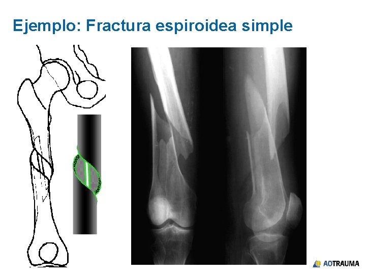 Ejemplo: Fractura espiroidea simple 