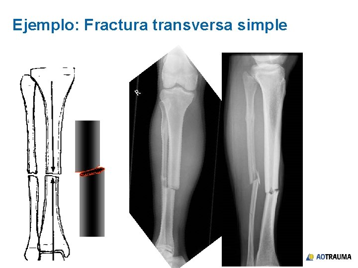 Ejemplo: Fractura transversa simple 