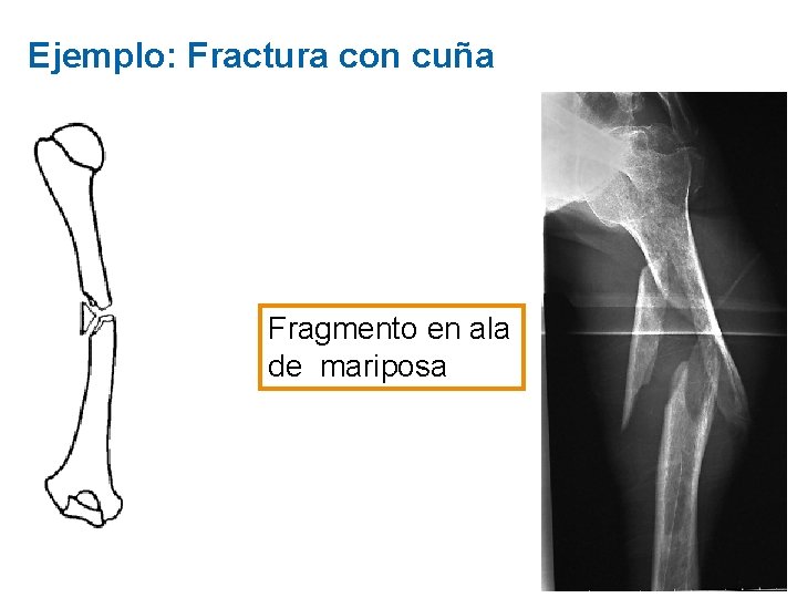 Ejemplo: Fractura con cuña Fragmento en ala de mariposa 