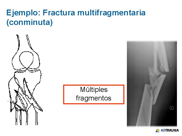 Ejemplo: Fractura multifragmentaria (conminuta) Múltiples fragmentos 