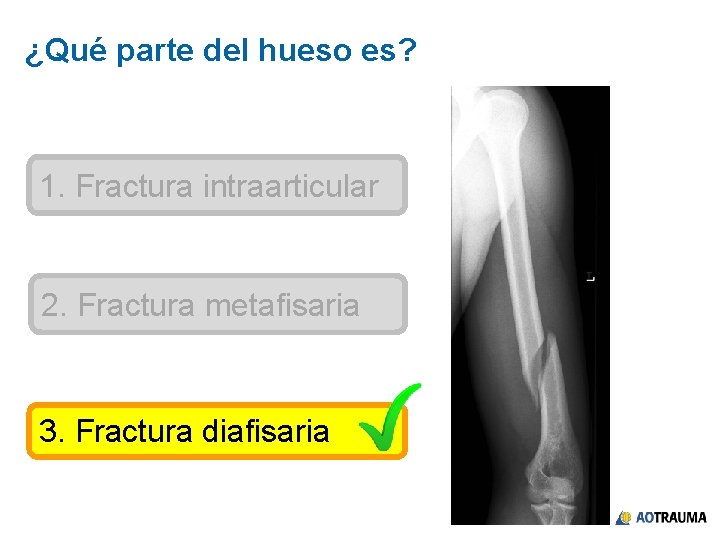 ¿Qué parte del hueso es? 1. Fractura intraarticular 2. Fractura metafisaria 3. Fractura diafisaria