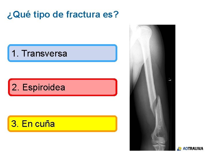 ¿Qué tipo de fractura es? 1. Transversa 2. Espiroidea 3. En cuña 