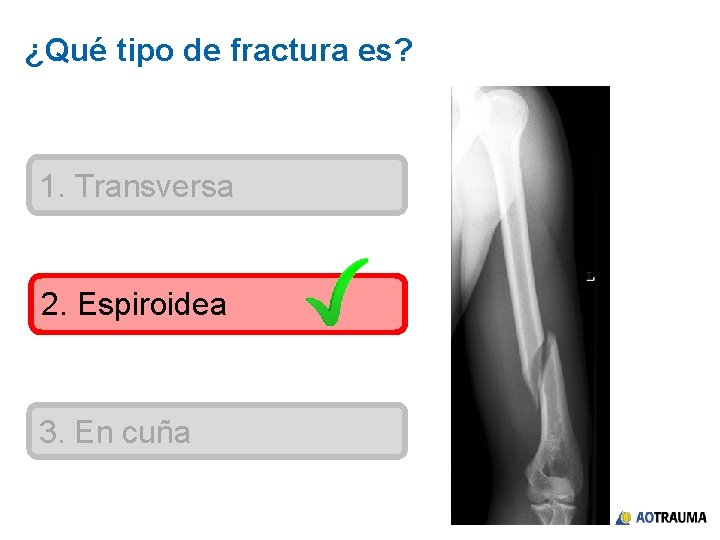 ¿Qué tipo de fractura es? 1. Transversa 2. Espiroidea 3. En cuña 