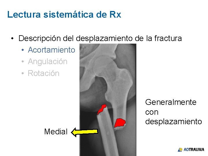 Lectura sistemática de Rx • Descripción del desplazamiento de la fractura • Acortamiento •