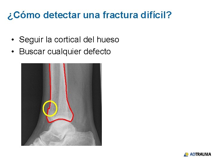 ¿Cómo detectar una fractura difícil? • Seguir la cortical del hueso • Buscar cualquier