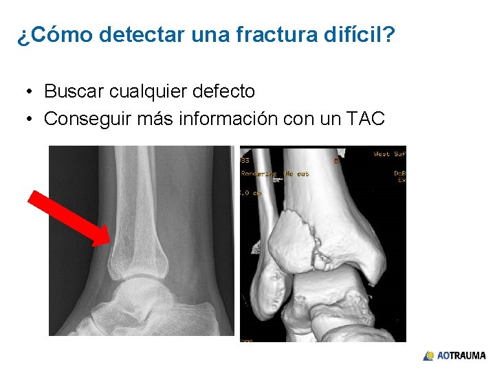 ¿Cómo detectar una fractura difícil? • Buscar cualquier defecto • Conseguir más información con