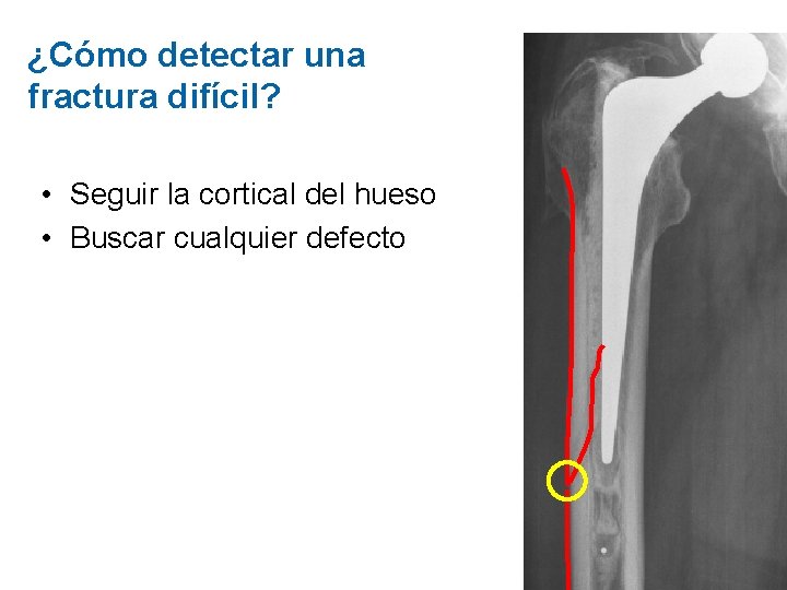 ¿Cómo detectar una fractura difícil? • Seguir la cortical del hueso • Buscar cualquier