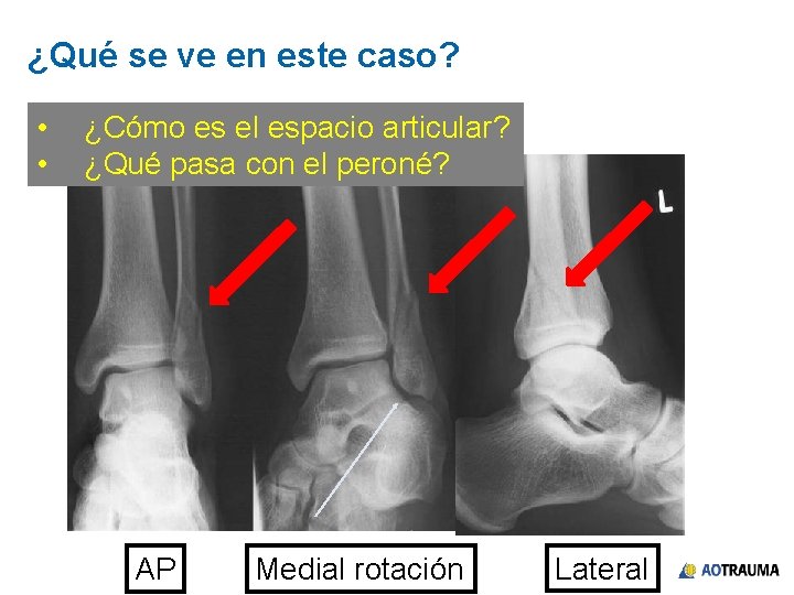 ¿Qué se ve en este caso? • • ¿Cómo es el espacio articular? ¿Qué