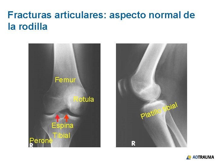 Fracturas articulares: aspecto normal de la rodilla Femur Rotula Espina Tibial Peroné ial b