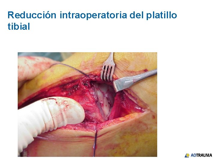 Reducción intraoperatoria del platillo tibial 