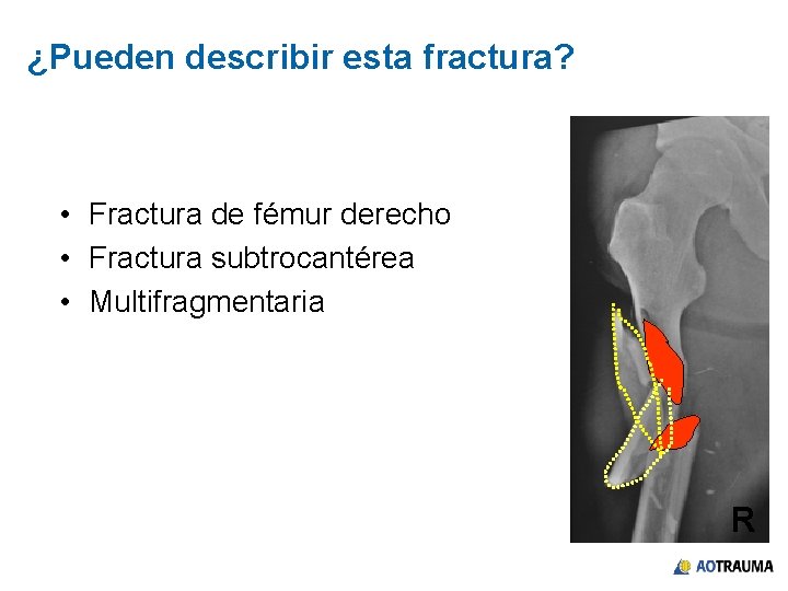 ¿Pueden describir esta fractura? • Fractura de fémur derecho • Fractura subtrocantérea • Multifragmentaria
