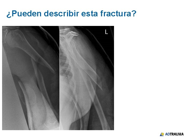 ¿Pueden describir esta fractura? 