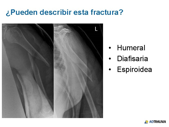 ¿Pueden describir esta fractura? • Humeral • Diafisaria • Espiroidea 