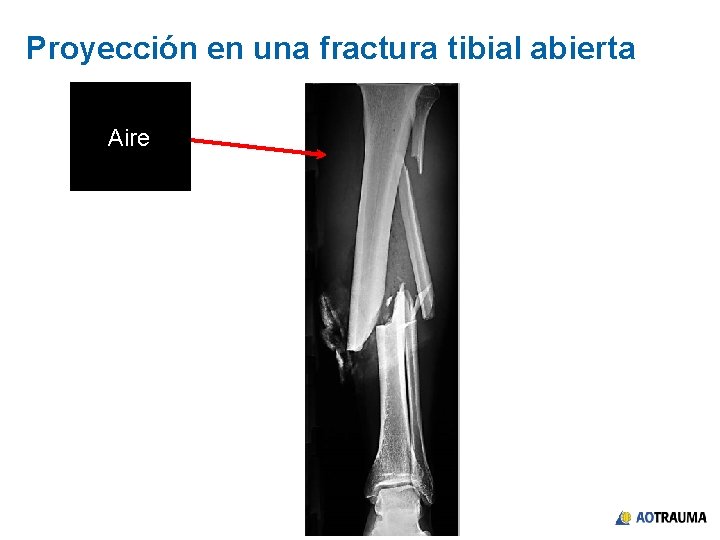 Proyección en una fractura tibial abierta Aire 