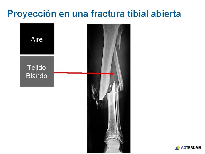 Proyección en una fractura tibial abierta Aire Tejido Blando 