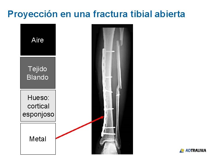 Proyección en una fractura tibial abierta Aire Tejido Blando Hueso: cortical esponjoso Metal 