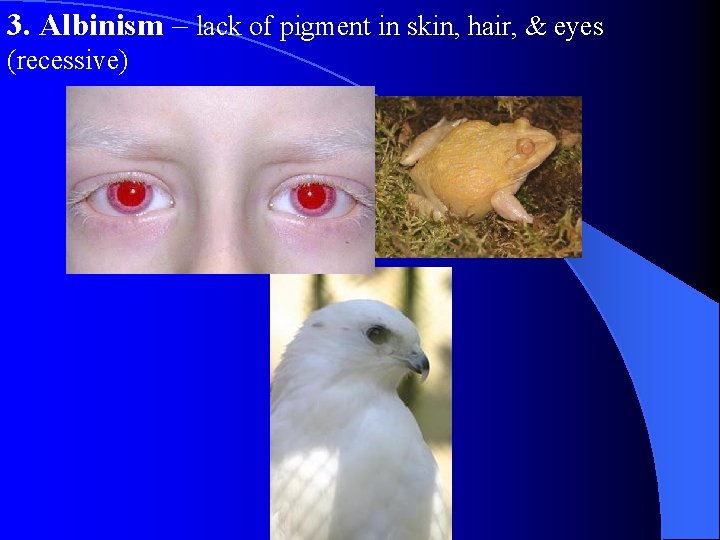 3. Albinism – lack of pigment in skin, hair, & eyes (recessive) 3. Albinism – lack of pigment in skin, hair, & eyes (recessive)
