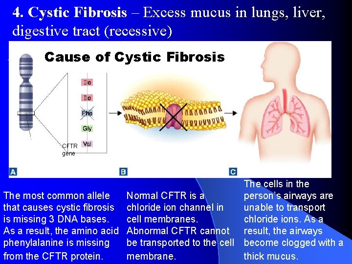 4. Cystic Fibrosis – Excess mucus in lungs, liver, digestive tract (recessive) Cause of 4. Cystic Fibrosis – Excess mucus in lungs, liver, digestive tract (recessive) Cause of
