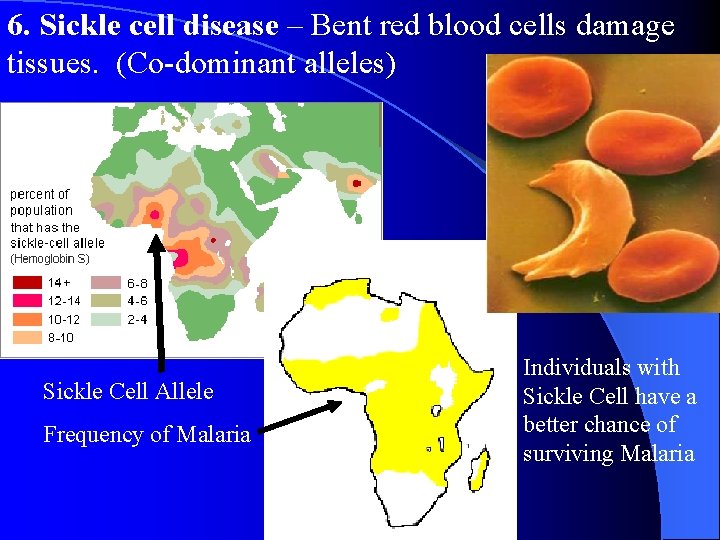 6. Sickle cell disease – Bent red blood cells damage tissues. (Co-dominant alleles) Sickle 6. Sickle cell disease – Bent red blood cells damage tissues. (Co-dominant alleles) Sickle