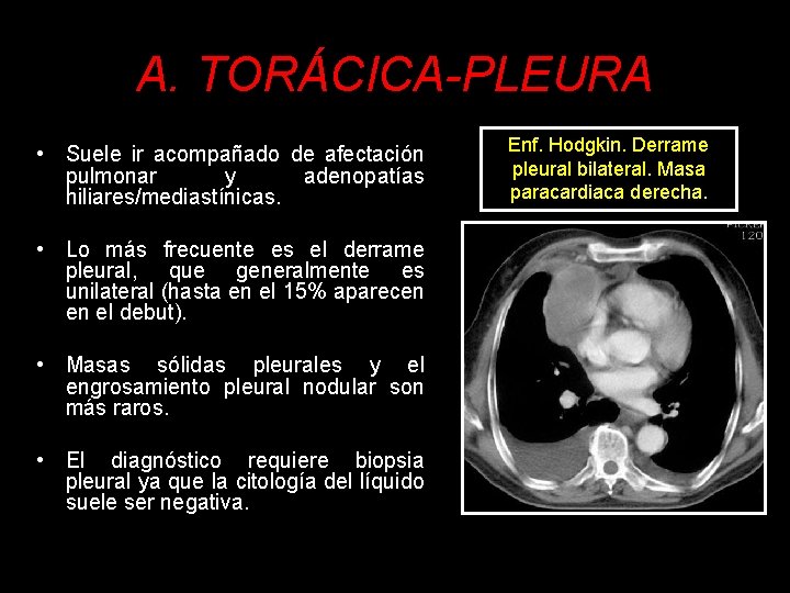 A. TORÁCICA-PLEURA • Suele ir acompañado de afectación pulmonar y adenopatías hiliares/mediastínicas. • Lo