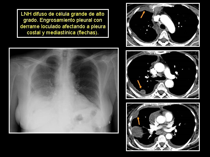LNH difuso de célula grande de alto grado. Engrosamiento pleural con derrame loculado afectando
