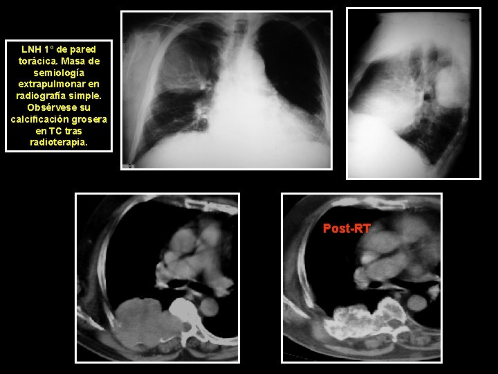 LNH 1º de pared torácica. Masa de semiología extrapulmonar en radiografía simple. Obsérvese su